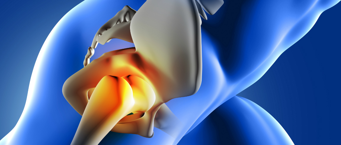 traumatología madrid | artrosis y prótesis de cadera